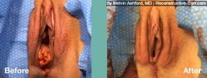 Vaginoplasty