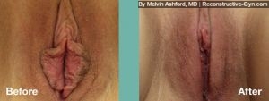 Labiaplasty Before and After