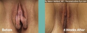Labiaplasty
