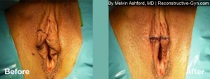 Labiaplasty