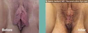 Labiaplasty