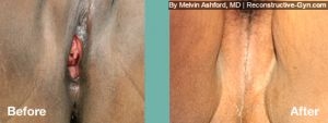 Vaginoplasty