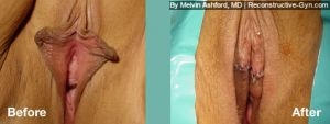 Labiaplasty