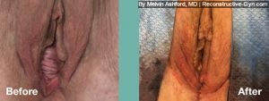 Vaginoplasty