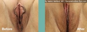Labiaplasty
