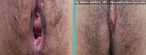 Vaginoplasty